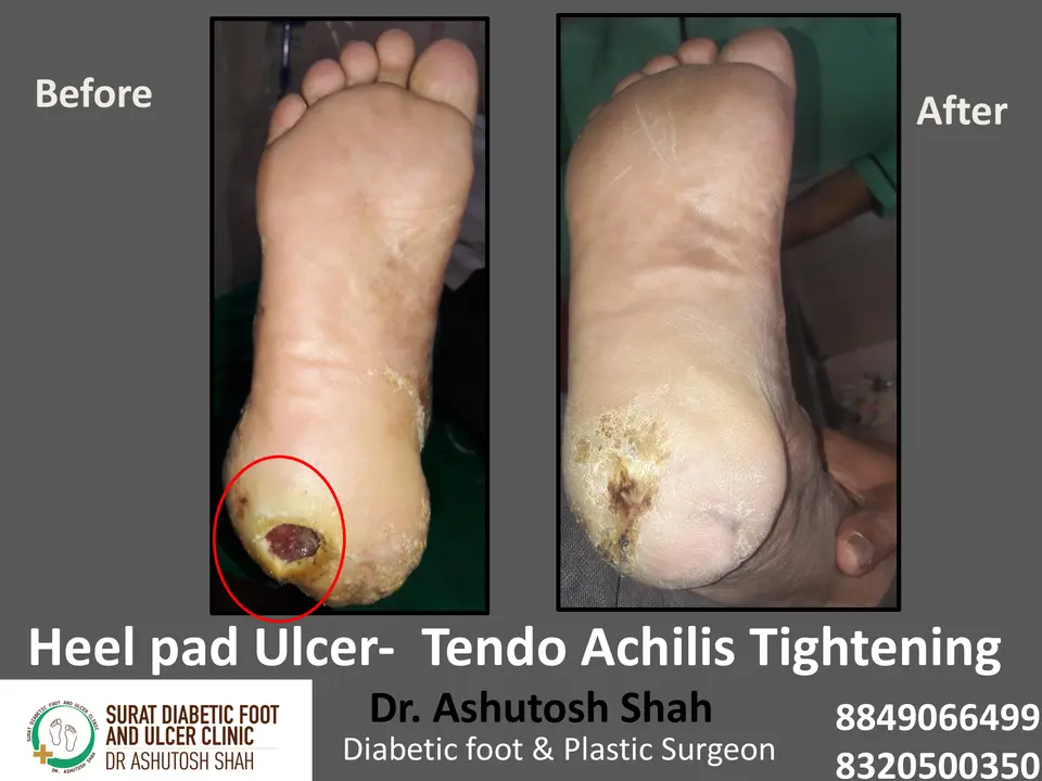 Diabetic Foot  PPT 3 checked by sir.pptx-54.webp